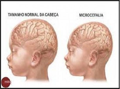 101215-cotidiano-microcefalia 410 305
