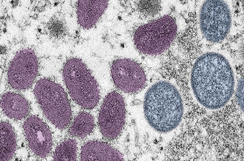 Saúde do Acre notifica caso suspeito de monkeypox nesta terça-feira