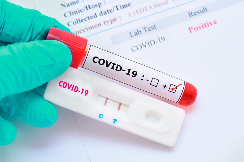 Acre registra 123 novos casos de coronavírus nesta sexta-feira