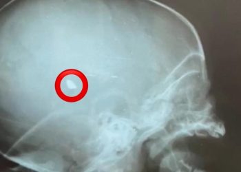 Bebê de dois meses atingido por tiro em Rio Branco segue na UTI e com bala alojada na cabeça