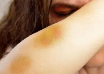 Nova lei permite que vítima de violência doméstica tenha prioridade em cirurgia reparadora no SUS