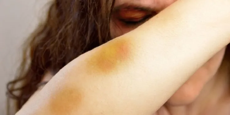 Nova lei permite que vítima de violência doméstica tenha prioridade em cirurgia reparadora no SUS