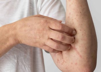 MPF e MPAC recomendam medidas de prevenção e tratamento para casos de Febre do Oropouche