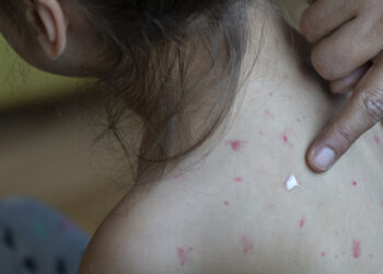 Casos suspeitos de sarampo sobem para 22 no Acre e autoridades reforçam alerta