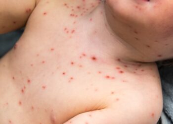 Acre investiga sete casos suspeitos de sarampo; 25 já foram descartados