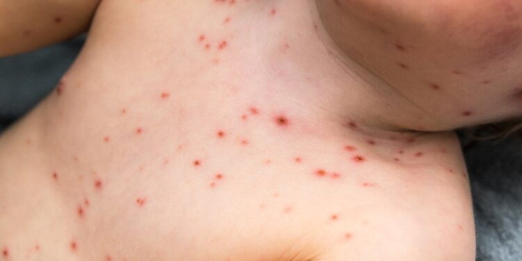 Acre investiga sete casos suspeitos de sarampo; 25 já foram descartados