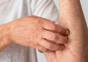 Acre se prepara para possíveis casos de Mpox após confirmação em Rondônia