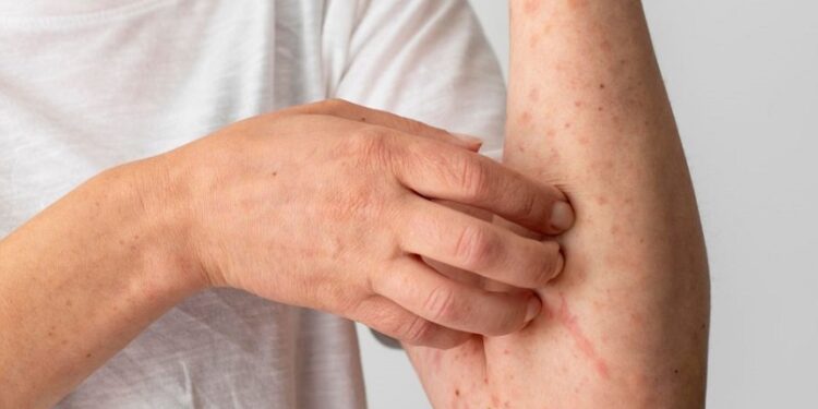 Acre se prepara para possíveis casos de Mpox após confirmação em Rondônia