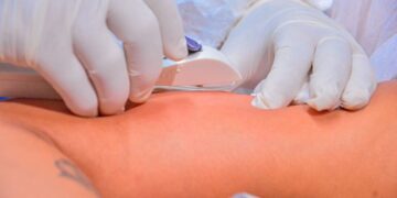 Saúde de Rio Branco realiza mutirão de inserção de Implanon e atende mais de 200 adolescentes