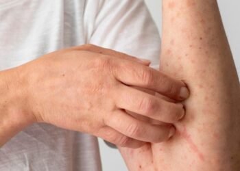 Diagnóstico de Mpox no Acre reforça importância do diagnóstico rápido e isolamento imediato