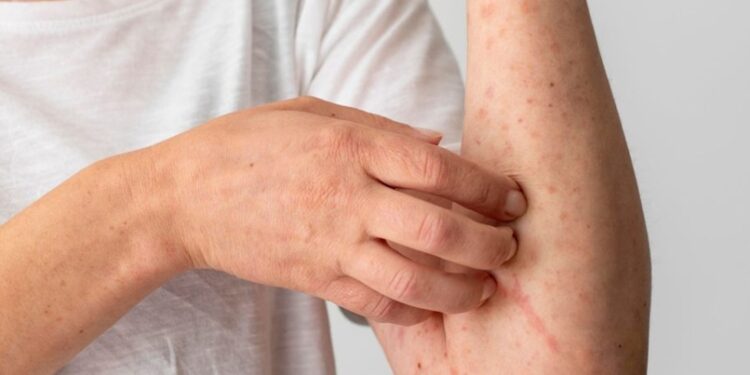 Após caso no Acre, veja sintomas e como se proteger da mpox