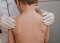 Criança de 7 anos é diagnosticada com meningite bacteriana em Cruzeiro do Sul