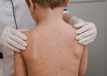 Criança de 7 anos é diagnosticada com meningite bacteriana em Cruzeiro do Sul