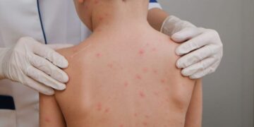 Criança de 7 anos é diagnosticada com meningite bacteriana em Cruzeiro do Sul