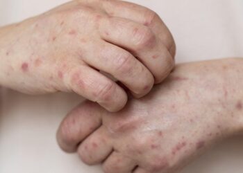 Rio Branco amplia combate à hanseníase após alta de casos no Acre